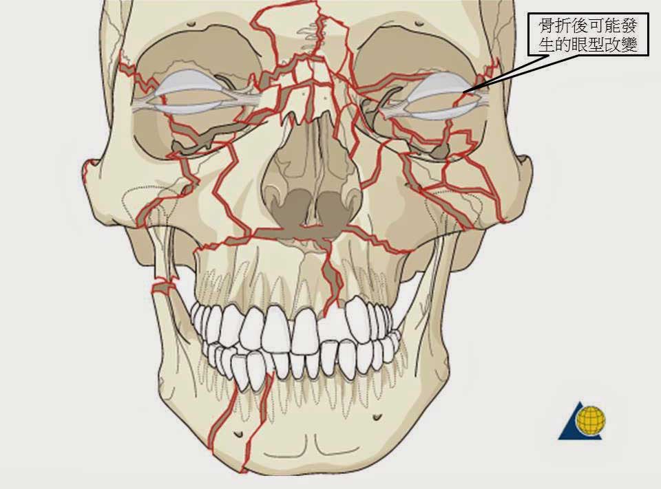 陳怡傑醫師 從顴骨骨折的治療觀點談顴骨削骨手術 群英整形外科診所