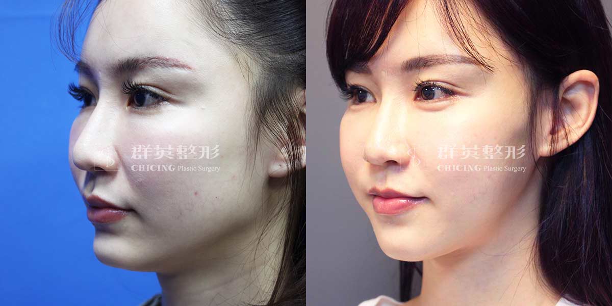 chin surgery before and after
