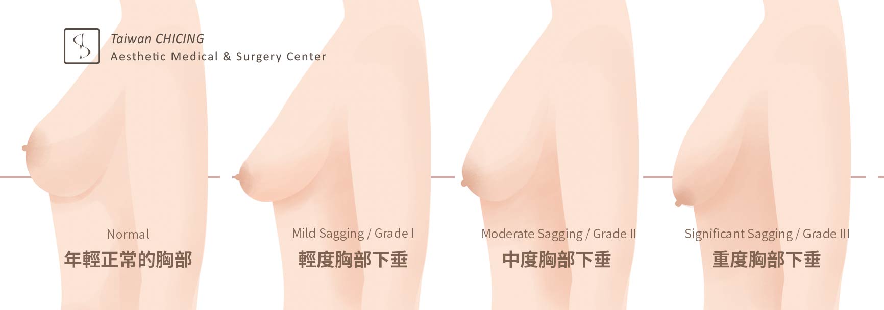胸部下垂_二次隆乳_提乳手術_謝禎祥醫師