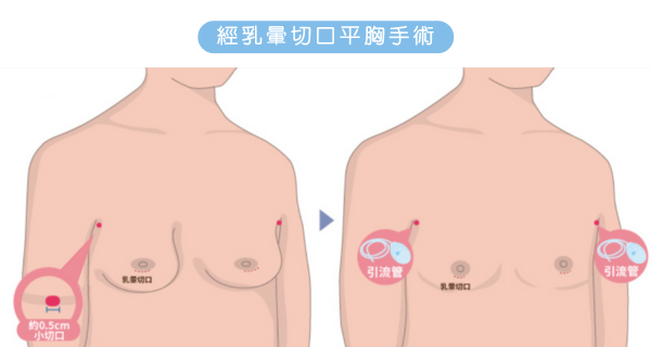 平胸手術_洪章桂醫師_乳暈切口