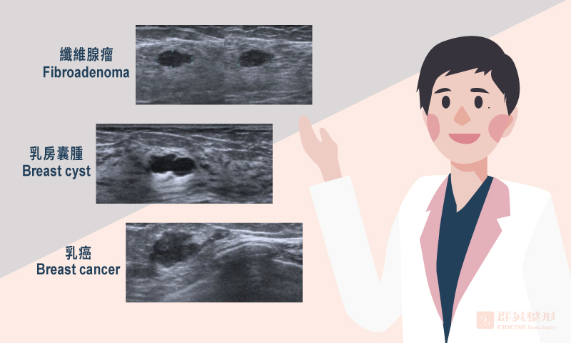王亭雅醫師_自體脂肪隆乳前為何要做乳房超音波?