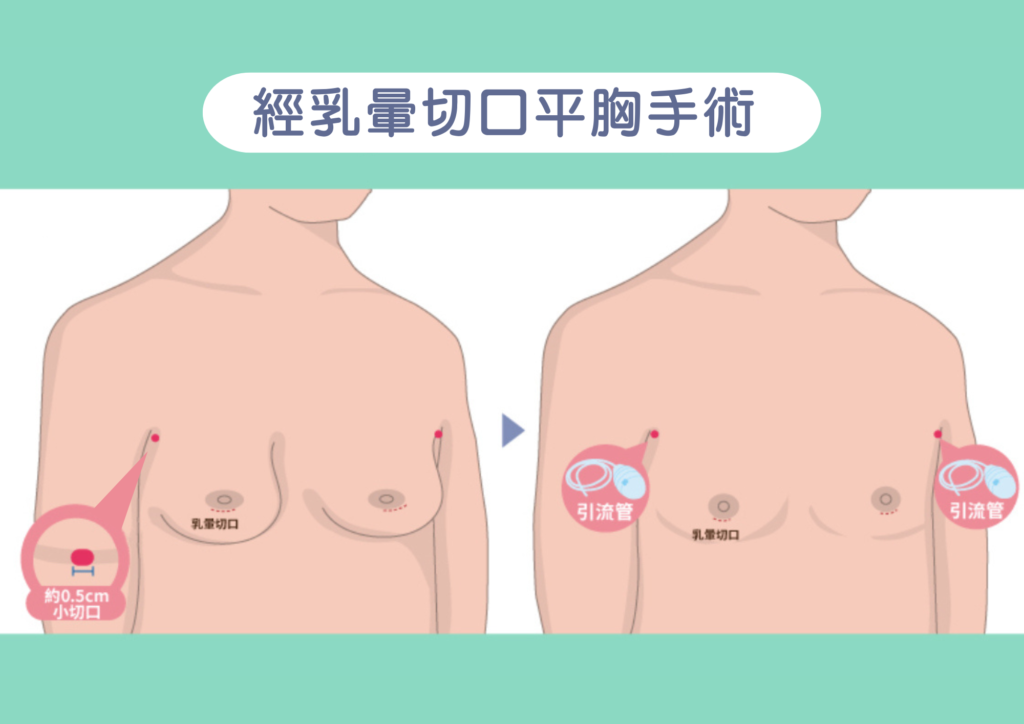 洪章桂醫師_女乳症治療_平胸手術_跨性別手術-乳暈切口