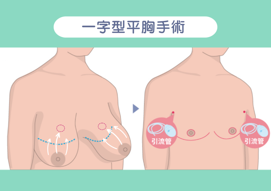 洪章桂醫師_女乳症治療_平胸手術_跨性別手術-一字型02