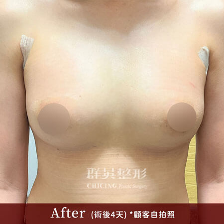 台中群英 陳大正醫師 柔滴隆乳 隆乳案例