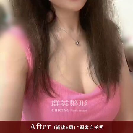 台中群英 陳大正醫師 柔滴隆乳 隆乳案例