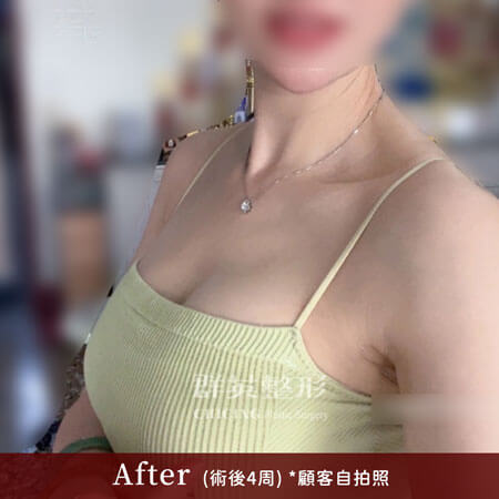 台中群英 陳大正醫師 柔滴隆乳 隆乳案例